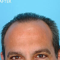 FUE-AFTER-4 FUE-AFTER-4