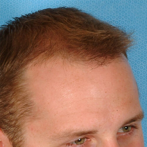 bauman-hair-28yr-man bauman-hair-28yr-man